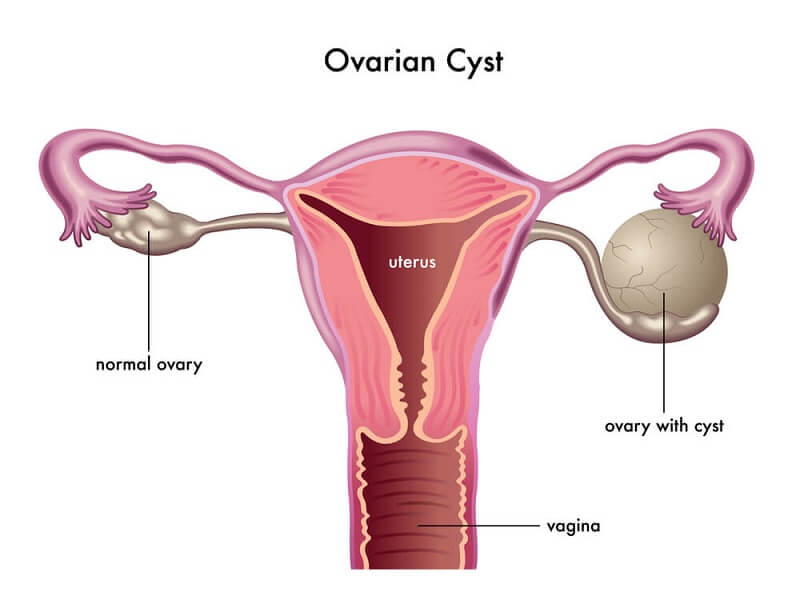 CAN OVARIAN CYSTS CONTRIBUTE TO INFERTILITY?: Rocky Mountain Fertility  Center: Reproductive Endocrinologists